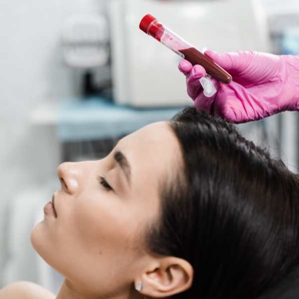 PRP Facial en la clínica de medicina estética Madrid PRP Facial en la clínica de medicina estética Madrid
