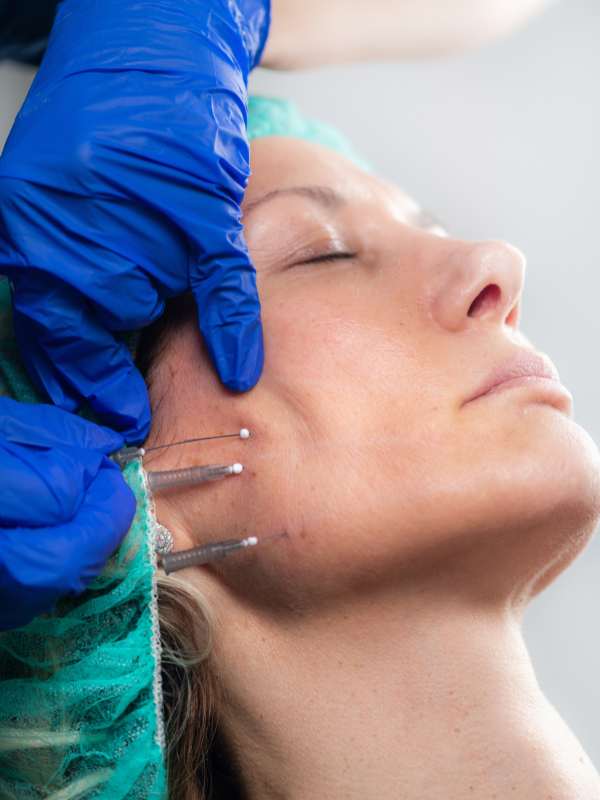 nuestros tratamientos de hilos tensores en la clínica de medicina estética en Madrid DA nuestros tratamientos de hilos tensores en la clínica de medicina estética en Madrid DA