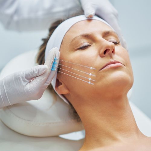 Hilos Tensores en la clínica de medicina estética DA en Madrid Hilos Tensores en la clínica de medicina estética DA en Madrid