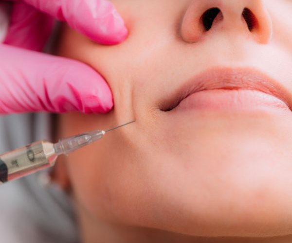 lineas de marioneta en Madrid. Tratamiento Clinica Medicina Estetica DA