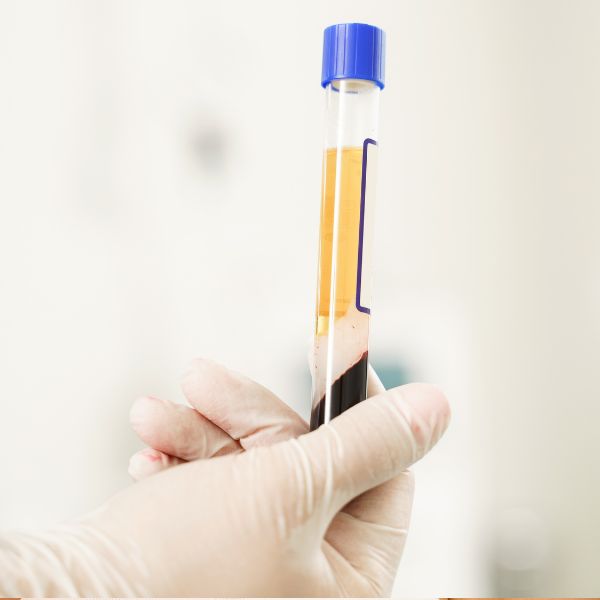 Plasma rico en plaquetas tratamiento PRP en Madrid Plasma rico en plaquetas tratamiento PRP en Madrid