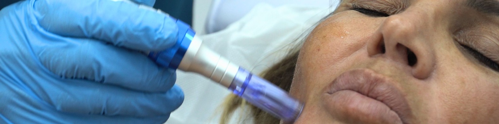 Dermapen Facial Madrid. Tratamiento de rejuvenecimiento facial en la Clínica de Medicina Estetica DA