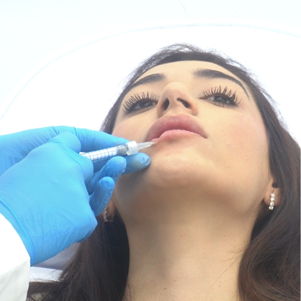 Aumento y perfilado de labios paciente de la Clínica de Medicina Estética DA en Madrid Aumento y perfilado de labios. Paciente de la Clínica de Medicina Estética DA en Madrid