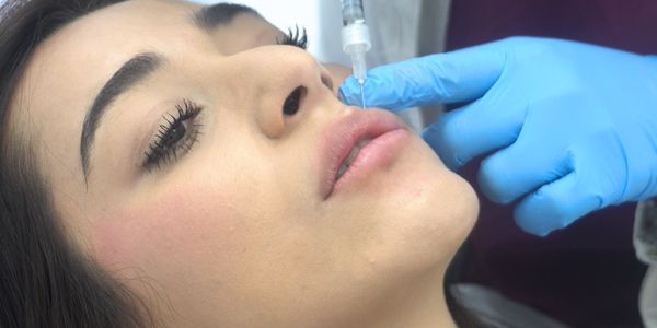 aumenta o hidrata los labios en la clinica de medicina estetica Madrid. Paciente de DA aumenta o hidrata los labios en la clinica de medicina estetica Madrid. Paciente de DA