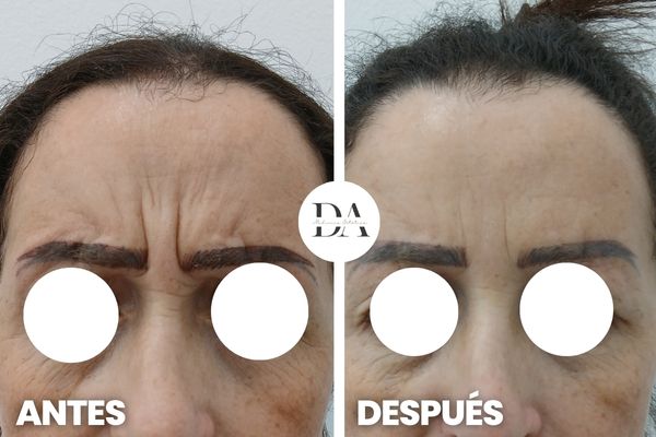 Antes y después bótox Madrid Entrecejo Clínica DA